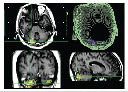 Figure 2. The SRS plan of brain tumors; gamma knife treatment (25 Gy in 5 fractions, 53% isodose curve).