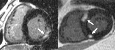 Figure 1. Typical Hyperenhancement in AFD (L) vs a common pattern in HCM (R).