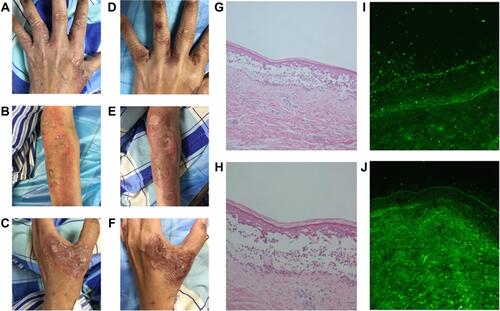 Figure 1 Clinical manifestation and histopathological findings of herpetiformis-type drug-induced pemphigus caused by tislelizumab before and after glucocorticoid therapy. (A–C) Clinical manifestation before glucocorticoid therapy; (D–F) clinical manifestation after glucocorticoid therapy; (G and H) histopathological findings: epidermal spongiosis, intraepidermal cleft, acantholytic cells in the bulla, edema and mixed type inflammatory infiltration containing eosinophils in the papillary dermis (H&E staining, G, ×100; H, ×200); (I and J) direct immunofluorescence (DIF) findings: intercellular intraepidermal C3 deposition (I) and IgG deposition (J) within the lower part of epidermis.