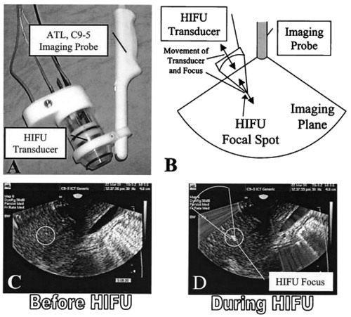 Figure 2. An integrated USgFUS system for real-time visualisation of lesion formation based on echogenicity change. Reproduced from Vaezy et al. [Citation125]. Reproduced with permission from IEEE and Elsevier Science and Technology Journals.