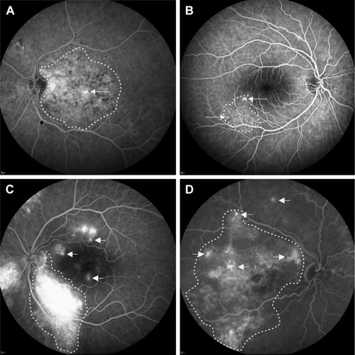 Figure 4 Four categories of eyes with severe chronic central serous chorioretinopathy with active fluorescein leakage on fluorescein angiography.