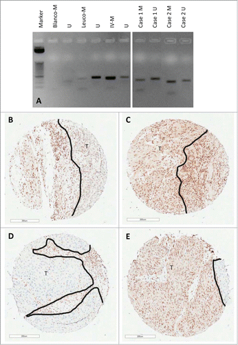 Figure 3. Examples of 2 cases that showed MGMT methylation, associated with low expression in the invasive tumor front, but high expression in the tumor center. (A) MGMT methylation controls [pure water, leucocytes, and IV (in vitro SssI methylated leucocytes)] and 2 cases. (B) Low MGMT expression in the tumor invasive front (Case 1). (C) High MGMT expression in the tumor center (Case 1). (D) Low MGMT expression in the tumor invasive front (Case 2). (E) High MGMT expression in the tumor center (Case 2). U: unmethylated; M: methylated; Blanco: pure water control; Leuco: leucocytes; IV: in vitro SssI methylated leucocytes. T: tumor tissue. The border of the tumor area is indicated by a black line.