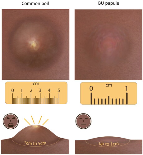 Figure 6. Help seeking: ‘the person feels that there is a small kind of boil… the papule is painless’. This figure represents a papule within the skin and comparing it to a boil. The points are a papule is smaller and painless, whereby a boil may look similar, but it is painful, and larger and develops a yellow pus. This reflects the senses of sight and touch. Illustration by Joanna Butler.