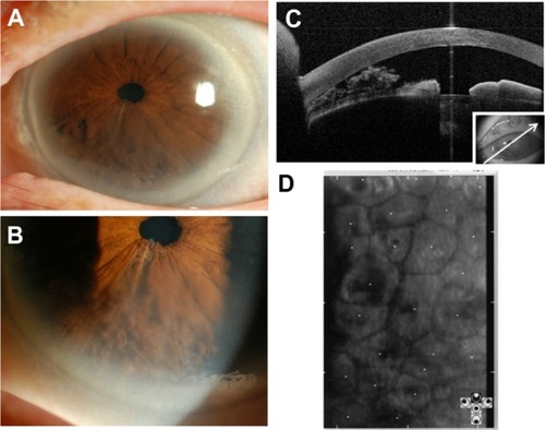 Figure 1 Slit lamp photographs, anterior segment optical coherence tomography (AS-OCT) image, and specular micrograph of the left eye before surgery. Slit lamp microscopy reveals iridoschisis in the inferior quadrant (A) and partial corneal edema in this portion (B). AS-OCT depicts a shallow anterior chamber with a separated anterior leaf of the iris touching the corneal endothelium (C). Specular microscopy of superior cornea shows endothelial cell loss (D).
