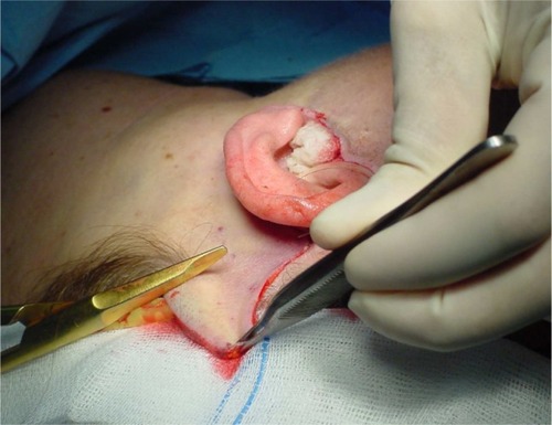 Figure 1 Excess skin is removed.