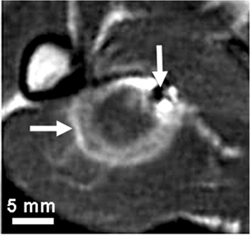 Figure 1. A typical T2-weighted in vivo MR image acquired minutes after ablation. The thermal lesion (horizontal arrow) is the bright elliptical region that has an isointense inner region surrounded by a hyperintense outer region. The small dark region (vertical arrow) is an MR image artifact of a fiducial needle inserted after the ablation, which was used to align the MR and tissue image volumes.