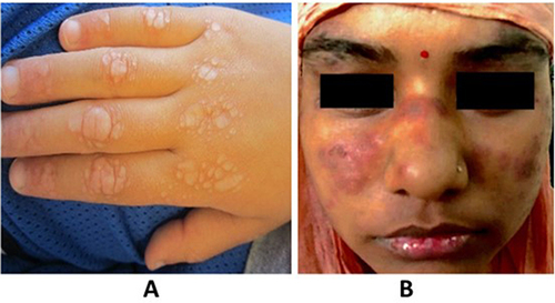 Figure 3 (A) Gottron’s papules on the dorsal aspect of the hand; (B) malar rash sparing nasolabial fold: notice the “butterfly” spread. Copyright (2022) ACR.