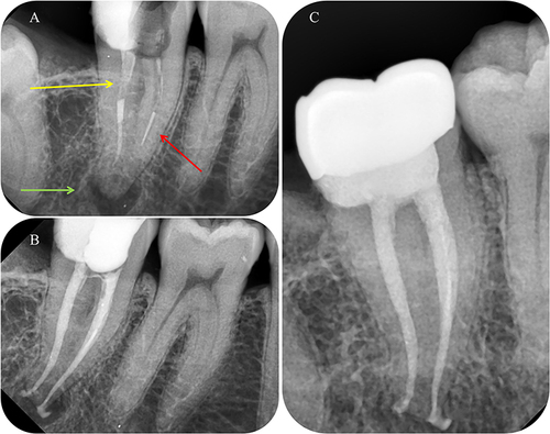 Figure 4 Clinical example of RCRt with several problems: fiber post in the distal root (yellow arrow), instrument fragment in the mesio-buccal canal (red arrow), apical part of the endodontic system non-instrumented and obturated, chronic periapical lesion (green arrow).