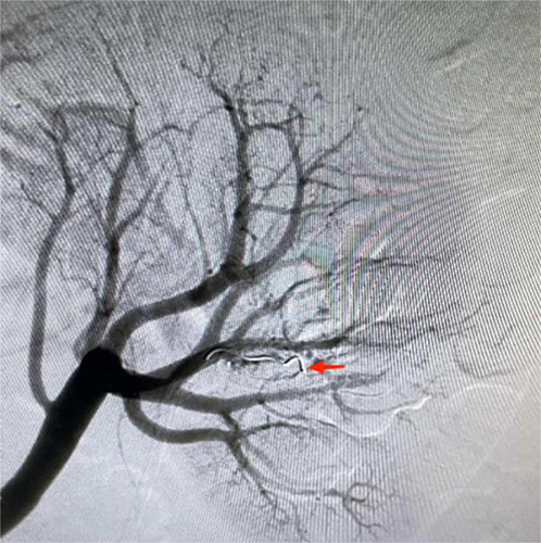 Figure 2 The first instance of SRAE showing the embolized artery with a coil (red arrow).
