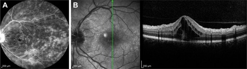 Figure 2 Fluorescein angiography of a 46-year-old female with sarcoidosis showing diffuse fluorescein pooling and leakage (A) and intraretinal fluid accumulation at the macula on optical coherence tomography (B).