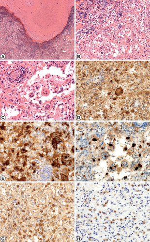 Figure 1. Morphological characteristics of Rosai-Dorfman disease (RDD). (A) Histologically, a cell-rich lesion with inflammatory stroma is visible, resulting in plaque-like thickening of the dura mater. The lesion is clearly separated from the normal brain tissue, and is not infiltrative. On low-magnification, the lesion mimics an inflammatory pseudotumor (hematoxylin and eosin [HE], 2.5x). (B) A mixture of vessels, collagen fibres, lymphocytes, and plasma cells are present, in specific, perivascular orientation, alongside with large histiocytes located in tissue gaps. The histiocytes have abundant, clear cytoplasm, with incorporated lymphocytes. The phenomenon is called emperipolesis, a characteristic feature of RDD (HE, 20x). (C) Histologic features of emperipolesis. Frequently, the histiocytes have vesicular chromatin pattern, and dot-like nucleoli. The vessels are surrounded by lymphocytic mantles (HE, 40x). (D) With cluster of differentiation 68 (CD68) immunohistochemistry (IHC) reaction, intensive, granular cytoplasmic positivity is seen in the histiocytes (CD68, 40x). (E) RDD histiocytes show aberrant S100 protein positivity. The ingested lymphocytes remain negative with this marker (S100, 40x). (F) A particular feature of RDD is the histiocyte nuclear positivity with cyclin D1 IHC. The ingested lymphocytes are negative (cyclin D1, 40x). (G) The plasma cells reflect Immunoglobulin G (IgG) positivity (IgG, 40x). (H) The majority of plasma cells are IgG4 positive (IgG4, 40x).