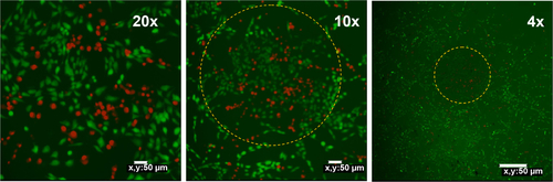 Figure S5 Confocal fluorescent microscopy images of MCF-7 cells incubated with 50 μg mL−1 UCN-Ce6 counterstained with fluorescein diacetate/propidium iodide after 980 nm NIR irradiation.Note: This figure shows localised targeting effect based on the site of irradiation. Dotted yellow circles define the area which is exposed to 980 nm irradiation.Abbreviations: Ce6, chlorin e6; NIR, near-infrared; UCN, upconversion nanoparticle.