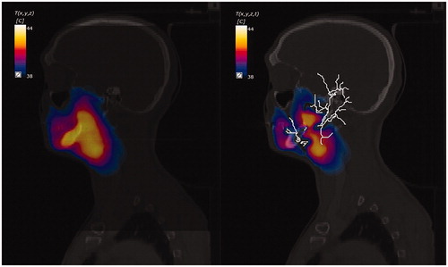 Figure 5. Example temperature distribution maps overlaid on CT images for PBHE (left), and DIVA (right).