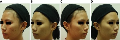 Figure 2 (A) Acne reduction compared between before (baseline) and (B) after treatment (at week 7) on the facial side treated with PDT with RT gel. (C) Acne reduction compared between before (baseline) and (D) after treatment (at week 7) on the facial side treated with PDT with ALA.