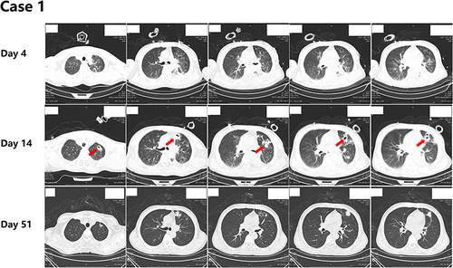 Figure 3 Lung CT scans obtained of case 1.
