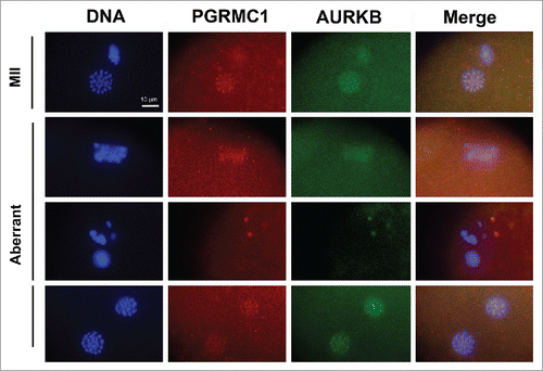 Figure 7. Effect of AG205 on PGRMC1 and AURKB localization. Representative images showing PGRMC1 and AURKB localization in MII plates of matured oocytes or in oocytes showing aberrant meiotic figures. COC were treated with 0 or 20 µM AG205 for 24 h. After AG205 treatment oocytes were fixed, immunostained with anti- PGRMC1 (red) and AURKB (green) antibodies; DNA was stained with DAPI (blue). A total of 97 oocytes from 2 independent experiments were analyzed. Both PGRMC1 and AURKB showed a focused centromeric localization in oocytes with MII plate, while they often showed a more diffused localization in aberrant meiotic figures with scattered chromosomes. When clumps of chromatin were present within the ooplasm, none of them were associated with AURKB and/or PGRMC1. Finally, when double meiotic plates were present, both AURKB and PGRMC1 showed a focused localization on metaphasic chromosomes of both plates.
