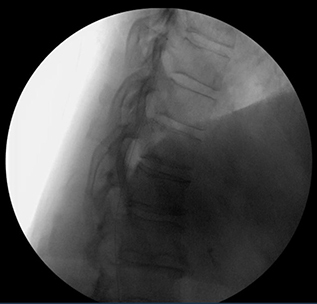 Figure 1 Fluoroscopic image intrathecal spinal catheter in the subarachnoid space.