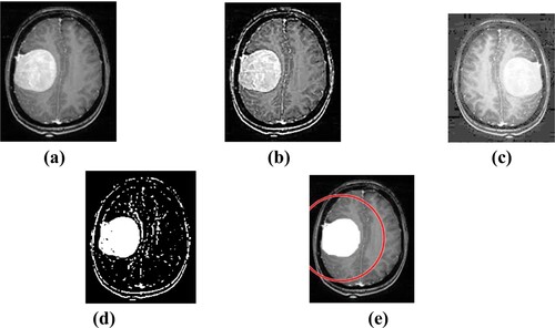 Figure 3. MRI outputs of brain (a), input image (b), pre-processed image (c), data augmentation brain image (d), segmented yield of brain MRI and (e) predicted MRI.