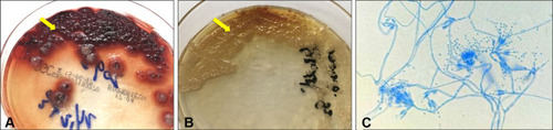 Figure 2 Talaromyces marneffei was isolated from the hilar nodes: Yellow colony with distinctive red diffusible pigment on Sabouraud’s dextrose slant at 25°C (A) and yellow colony on Sabouraud’s dextrose slant at 37°C (B). Lactophenol blue-stained culture of the ulcerating right supraclavicular subcutaneous mass showing that the conidiophores of this mold were smooth and had a size of 3 um, each of which had several phialides and produced smooth, spherical conidia in chains (C).