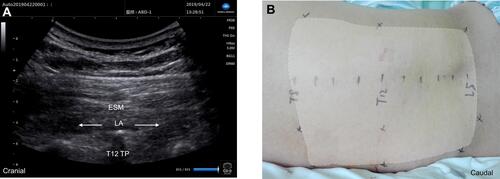 Figure 2 Longitudinal parasagittal ultrasound view (A) and extent of cutaneous sensory loss over the back at 40 minutes after the injection of 25 mL of 0.3% ropivacaine in one patient at the T12 level (B). Arrows represent the spread of local anesthetic. TP, transverse process; ESM, erector spinae muscle; LA, local anesthetic.