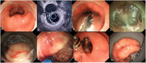 Figure 3. Submucosal tunneling endoscopic resection for a large submucosal esophageal lesion. (A) Endoscopic view of a ring-like tumor surrounding the esophagus. (B) Endoscopic ultrasonography view of the tumor. (C) A 2-cm longitudinal mucosal incision was made approximately 5 cm proximal to the SEL. (D) The submucosal tunnel is established. (E) The SEL is exposed using the submucosal tunnel technique. (F) Separating the tumor from the MP layer using the hybrid knife. (G) The mucosal entry incision is sealed with several clips. (H) Irregularly-shaped completely resected specimen (maximal diameter).