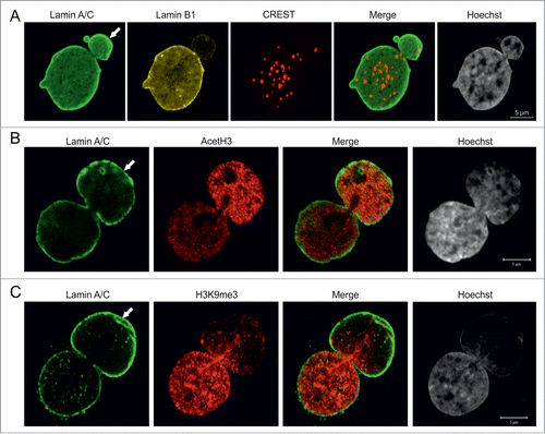Figure 2. Pericentric heterochromatin and epigenetic modifications of chromatin in blebs. (A) p.S143F fibroblasts (p17) were stained for LA/C, LB1 and centromeres. Hoechst was used to visualize DNA. The maximum projection of series of z-sections covering the entire nucleus are shown. A single centromere spot is found in the bleb region (arrow). Scale bar 5 μm. (B) p.S143F fibroblast (p17) stained for LA/C and acetylated histone H3 (AcetH3). A single mid-plane confocal section is shown. The intensity for AcetH3 is increased in the bleb region (arrow). Scale bar 5 μm. (C) p.S143F fibroblast (p17) stained for LA/C and histone H3 trimethylated at lysine 9 (H3K9me3). A single mid-plane confocal section is shown. H3K9me3 is reduced in the bleb region (arrow). Scale bar 5 μm.