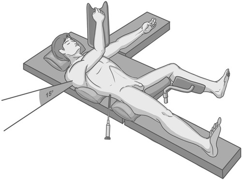 Figure 5 During puncture and stone fragmentation, the right leg was returned to the center to avoid disturbance of puncture site and limitation of nephroscope movement.