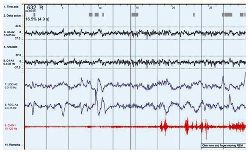 Figure 3 A 30-second epoch from a polysomnograph demonstrating the changes in REM behavior disorder.