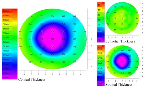 Figure 11 Examples of very smooth epithelium of a patient subjected to CXL.