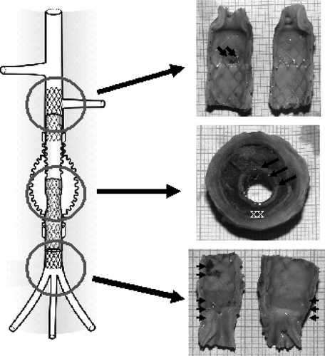 Figure 5.  Gross observation after dissection of a stent-graft implanted for 3 months. The flow surface of the proximal and distal segments, i.e., contact with the host artery, are smooth and glistening. Proximally, the blood supply of the kidney does not suffer impairment as the bare stent is kept open vis-à-vis the ostia of the left kidney artery (double arrows). The luminal surface of the medium segment is immature as bare stent struts and polyester knit are exposed to the blood flow (triple arrows). The stent-graft holds a reorganized sac capsule while the blood thrombus in the aneurismal sac has fully solidified but its reorganization is limited to the area in contact with the polyester of the stent-graft (X). The prosthetic aneurysm is well encapsulated (XX). Distally, the internal capsule encompasses all the bare stent (arrow head) with some minor mural thrombi (double arrow heads) while the distal extremity of the stent causes some overdistension of the aorta (triple arrow heads).