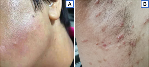Figure 1 Painful erythematous papules studded with white blisters on the patient’s left face (A) and right axillary skin (B).