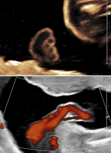 Figure 3 Umbilical cord of thoraco-omphalopagus twins at 23 weeks’ gestation. Upper panel: Axial image of the umbilical cord of thoraco-omphalopagus twins at 23 weeks’ gestation. Note the single umbilical vein and four (4) umbilical arteries (vessels are depicted en face). Lower panel: Doppler energy imaging of thoraco-omphalopagus twins at 23 weeks’ gestation. This image depicts a sagittal view of the umbilical vein, and adjacent four umbilical arteries. As in upper panel, note the single umbilical vein and four (4) umbilical arteries.