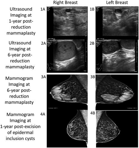 Figure 1. Imaging series showing progression of bilateral epidermal inclusion cysts of the breast. Ultrasound imaging: at one-year post-reduction mammaplasty (1A,1B) and at six-year post-reduction mammaplasty (2A,2B). Mammogram imaging at six-year post-reduction mammaplasty (3A,3B) and at one-year post-excision of epidermal inclusion cysts (4A,4B).