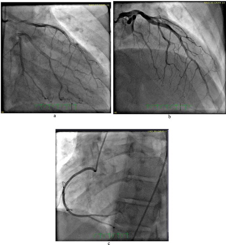 Image 4 Cath: Coronary angiogram showing arterial wall contrast staining with multiple radiolucent lumen in mid to distal left anterior descending artery consistent with type 1 spontaneous coronary artery dissection (SCAD) . Normal right coronary artery