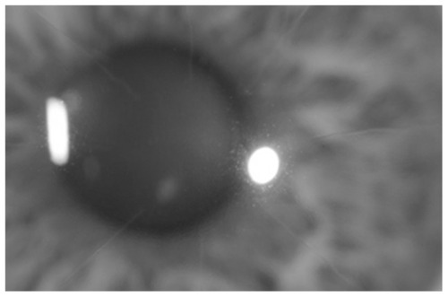 Figure 1 Slit lamp photo of Case 5 showing RK incisions and moderate central guttata.