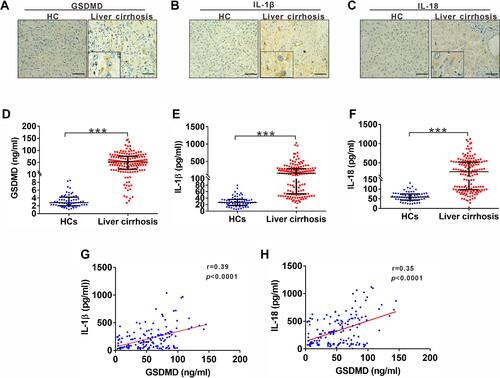 Figure 1 Expression of GSDMD, IL-1ß and IL-18 in patients with liver cirrhosis. (A-C) Representative IHC staining for GSDMD, IL-1ß and IL-18 in liver cirrhosis patients. Black scale bars, 100µm. (D) ELISA analysis of serum GSDMD levels in HC and liver cirrhosis patients. (E) ELISA analysis of serum IL-1ß levels in HC and liver cirrhosis patients. (F) ELISA analysis of serum IL-18 levels in HC and liver cirrhosis patients. (G) Correlation between serum IL-1ß and GSDMD in liver cirrhosis patients. (H) Correlation between serum IL-18 and GSDMD in liver cirrhosis patients. ***p<0.001.