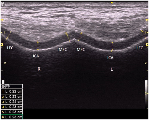 Figure 1. Ultrasonographic images (suprapatellar axial view) showing bilateral femoral cartilage measurements. ICA: intercondylar area; L: left; LFC: lateral femoral condyle; MFC: medial femoral condyle; R: right.