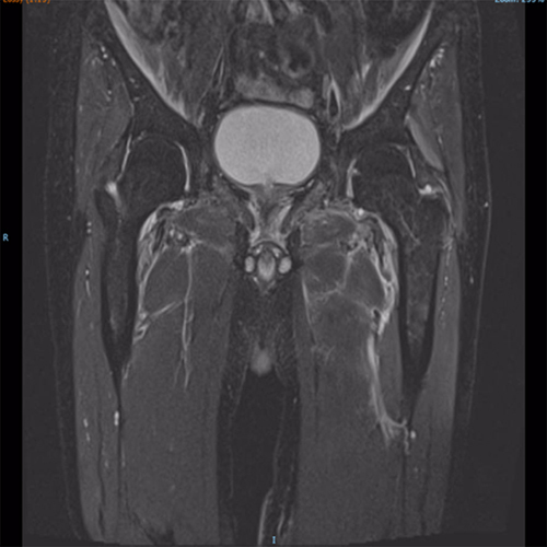 Figure 2 MRI with contrast showing diffuse T2 hyperintense swelling and enhancement involving bilateral iliacus muscles, distal psoas and iliopsoas tendons bilaterally.