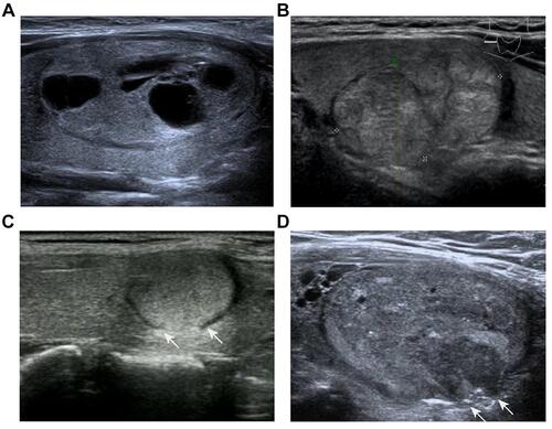 Figure 1 The ultrasonic imagings of FA and FTC. (A) Ultrasonic imaging of FA. The image showed an elliptic isoechoic nodule with smooth margins, thin and even peripheral halo, and accompanied by cystic changes. (B) Ultrasonic imaging of FTC. It resembled a large oval nodule that was subdivided into smaller nodules by the hypoechoic region, which was known as the “separated nodules sign” in this study. (C) Ultrasonic imaging of FTC. The image showed an elliptic isoechoic nodule with a discontinuous and irregular thick halo. Two white arrows indicated the discontinuous change of peripheral halo. (D) Ultrasonic imaging of FTC. The image showed an elliptic isoechoic nodule with irregular margins. Two white arrows indicated local irregular change.