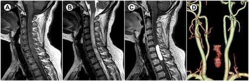 Figure 1 (A) T1-weighted magnetic resonance imaging showing an isointense mass. (B) T2-weighted imaging showing a hyperintense mass with associated spinal cord edema in the rostral region of the lesion. (C) Homogeneous enhancement after gadolinium administration. (D) Three-dimensional computed tomographic angiography reconstruction showing a high-flow hypervascular lesion.