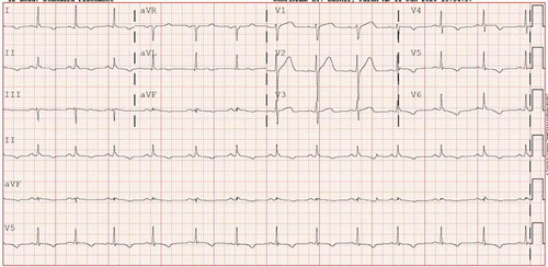 Figure 1. EKG showing early repolarization in anterior leads and diffuse T wave depression in multiple leads