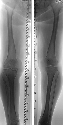 Figure 2 d. Long-leg standing radiographs at 65 years follow-up, showing slight varus of the right knee and leg length discrepancy of 1.5 cm with the right leg shorter.