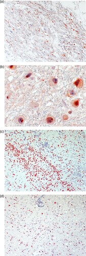 Figure 5. Detection of BoDV-1 antigen and RNA in brain tissue (case 2). A, Demonstration of viral antigen in neuropil and perikarya. Immunoperoxidase stain for BoDV-1 P antigen with light hematoxylin counterstain of the basal ganglia, original magnification x200. B, Presence of BoDV-1 antigen as spot-like nuclear inclusion or completely filling the nucleus. Immunoperoxidase stain for BoDV-1 P antigen with light hematoxylin counterstain of the pons, original magnification x1000. C, Detection of viral RNA. In situ-hybridization for BoDV-1 RNA of the hippocampus, original magnification x100. D, BoDV-1 RNA in the thalamus, in situ-hybridization, original magnification x100.