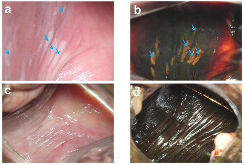 Figure 1. Endoscopic images of patients with VaIN I before and after treatment are shown in Figure 1. (a) Represents the appearance of the lesion site before treatment when 3% glacial acetic acid was applied. (b) Shows the lesion site before treatment when Lugol’s iodine solution was applied for recurrent staining. (c) Displays the lesion site after 6 months reexamination following treatment when 3% glacial acetic acid was applied. Finally, (d) demonstrates the lesion site after half a year’s reexamination following treatment when Lugol’s iodine solution was applied. The blue arrow indicates the location of the lesion in the images.