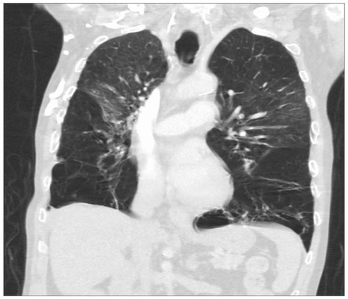 Figure 2 A computed tomography scan showing severe bilateral, lower lobe-predominant panacinar emphysema in a patient with AATD homozygous for the Z mutation.Abbreviation: AATD, alpha-1 antitrypsin deficiency.