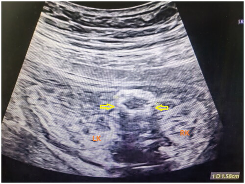 Figure 2. Intestinal dilatation in a prenatal ultrasound scan. RK: right kidney; LK: left kidney; Thick arrows represent calcified, thickened, and dilated intestinal tube walls.
