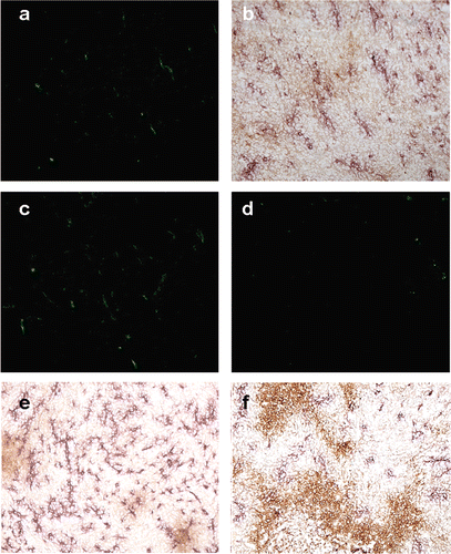 Figure 3. Tomato lectin-FITC and CD31 & hypoxyprobe staining. (a) Tomato lectin-FITC. (b) Same coordinates on the slide imaged for CD31 and hypoxyprobe staining. Area stained by CD31 is larger than FITC indicative of greater presence of the antigen than is actually patent functional vasculature. (c) Image from a control tumour section showing the patent vasculature in green. (d) IL-12 treated tumour 5 days post-hyperthermia showing reduced vasculature. (e) Section from a control group tumour showing large areas staining positive for CD31 antigen with small areas of hypoxia. (f) Section from a treated group tumour showing reduced CD31 staining and larger areas of hypoxia.