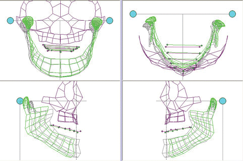 Figure 15. ManMoS simulation with priority given to the occlusal correction. [Color version available online.]