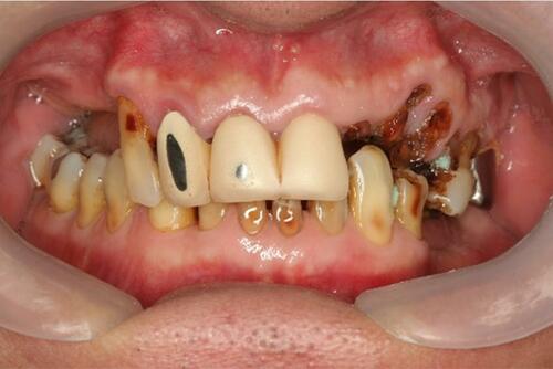 Figure 1 Frontal view, habitual occlusion.