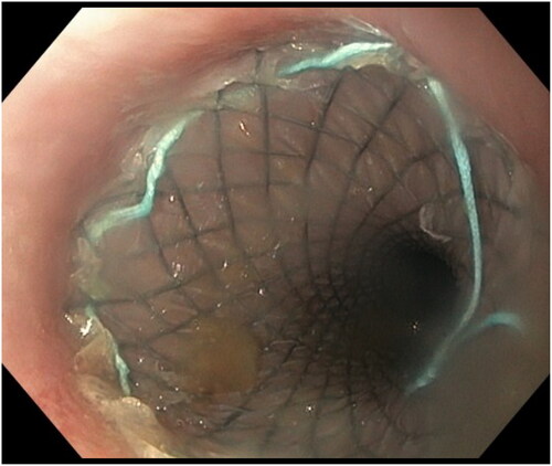 Figure 3. The stent covering the perforation.